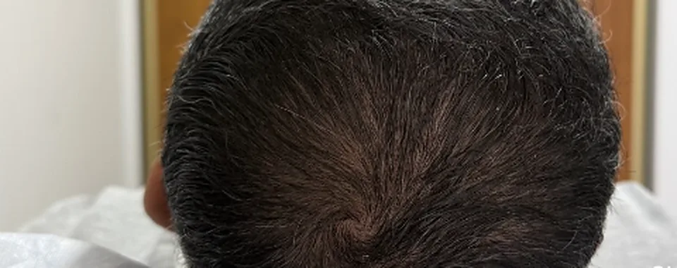 Coronilla después del tratamiento, con más densidad
